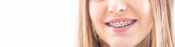 Attelle Dentaire Sur Les Dents Saines Une Jeune Adolescente Macro — Photo
