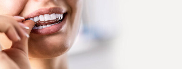A woman puts on an invisible silicone teeth aligner. Dental braces for teeth correction.