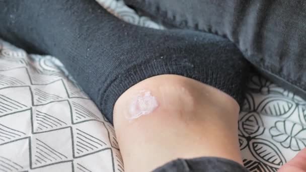 Mädchen mit Wunde am Bein, desinfiziert sich mit Spray. — Stockvideo