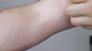 Hands of a man, he uses his hands to scratch his hand due to dermatitis and an itchy feeling