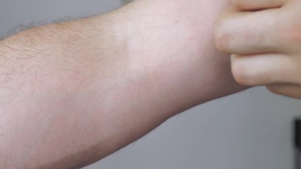 Hands Man Uses His Hands Scratch His Hand Due Dermatitis — Vídeo de stock