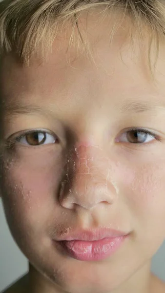 Peeling skin on human face from sunburn, peeling skin and skin care concept.