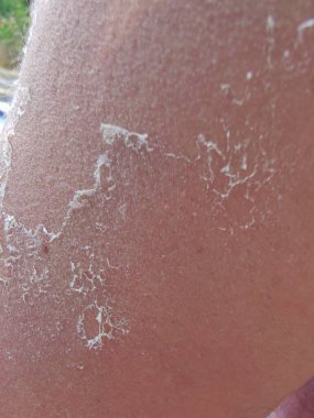 Skin on the arm that is peeled off due to sunburn.
