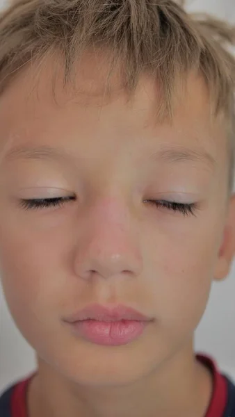 Ξεφλούδισμα Του Δέρματος Στο Ανθρώπινο Πρόσωπο Από Ηλιακό Έγκαυμα Ξεφλούδισμα — Φωτογραφία Αρχείου