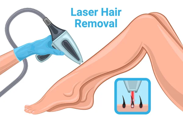 Laser Hair Removal Mulher Pernas desenhos animados isolados — Vetor de Stock