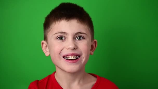 The boy is smiling, aligning his teeth with a dental plate, dental care. — Stock Video