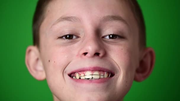 Senyum bayi, anak laki-laki memakai piring untuk menyelaraskan gigi, perawatan gigi. — Stok Video
