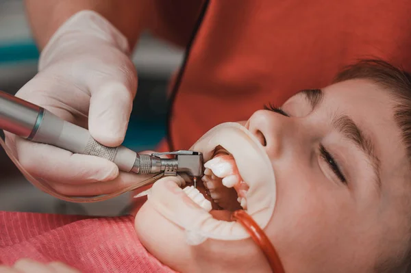 Zahnarzt Reinigt Karies Bei Einem Kind Mit Einer Bohrmaschine Den — Stockfoto