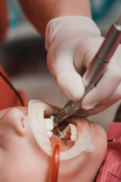 Dentista Limpa Cárie Dentária Uma Criança Com Uma Broca Boca — Fotografia de Stock