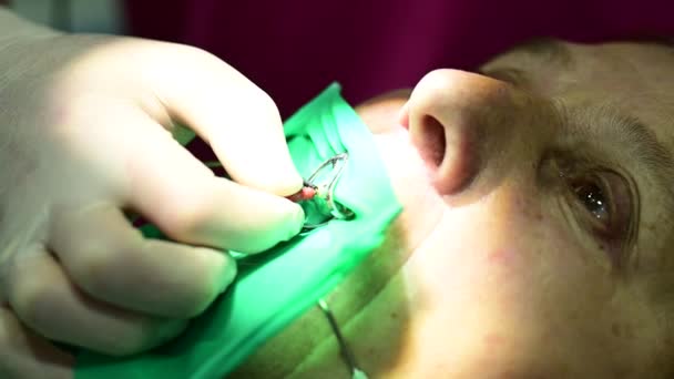 Dentista Utiliza Una Aguja Raíz Para Tratar Diente Aguja Dental — Vídeo de stock