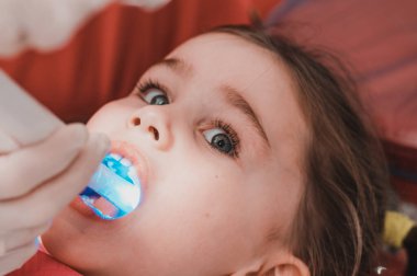 Ultraviyole diş hekimliğinde, dişçi çocuğun dişini çabucak kapatmak için ultraviyole ışınlı bir cihaz tutuyor, kız dolguyu sertleştirmek için ağzını açık tutuyor..