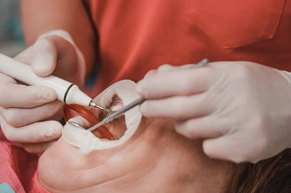 Dişçide Diş Tedavisi Doktor Hastanın Üst Dişlerini Tedavi Eder Ultrasonik — Stok fotoğraf