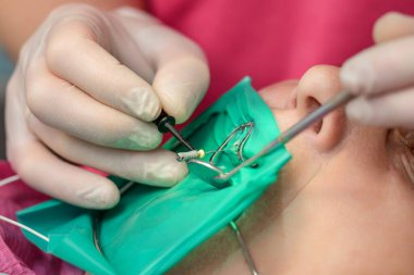 Diş kliniğinde yanak retraktörü olan bir hasta, lateks eldivenli bir dişçi dişlerini boron ve aynayla muayene ediyor, dişçiye gidiyor..