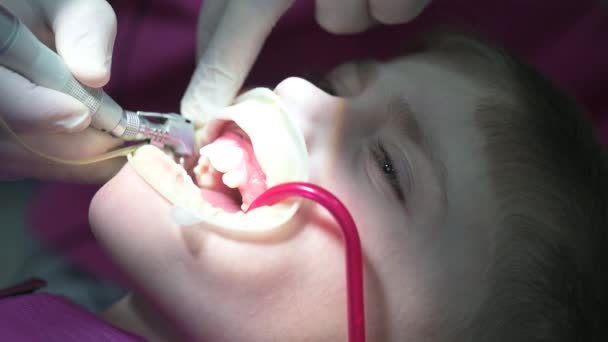Θεραπεία των δοντιών του μωρού σε ένα παιδί, ένας γιατρός τρυπά ένα δόντι για τερηδόνα. — Αρχείο Βίντεο