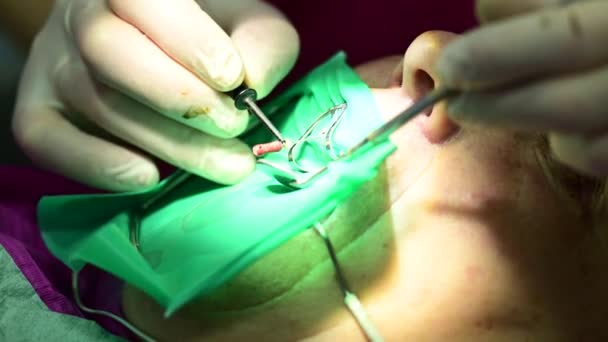 Il dentista usa un ago radice per trattare il dente. — Video Stock