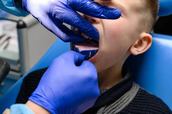 Kieferabdruck Mit Silikon Diagnosemodell Schiefe Zähne Beim Kind Besuch Beim — Stockfoto