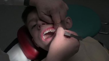 Ortodontist, öğrencilerin dişlerine diş teli takar. Eğri dişler kalıcı dişlere takılır..