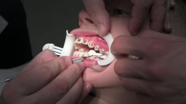 Ortodonta stosuje aparat ortodontyczny na zęby uczniów, krzywe zęby dzieci. — Wideo stockowe