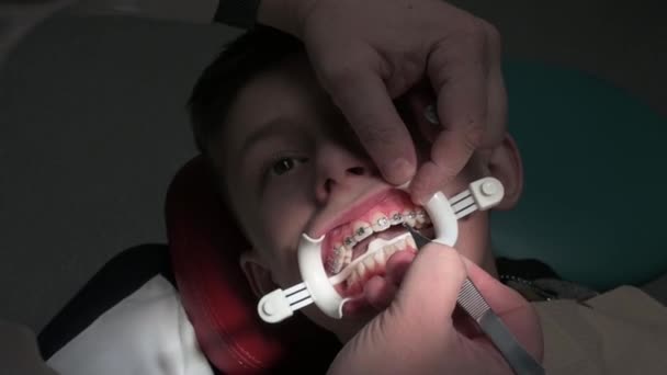 Ortodontist, öğrencilerin dişlerine diş teli takar. Eğri dişler kalıcı dişlere takılır.. — Stok video