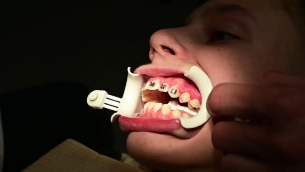 L'ortodontista applica l'apparecchio ai denti degli studenti, denti permanenti per bambini storti.. — Video Stock