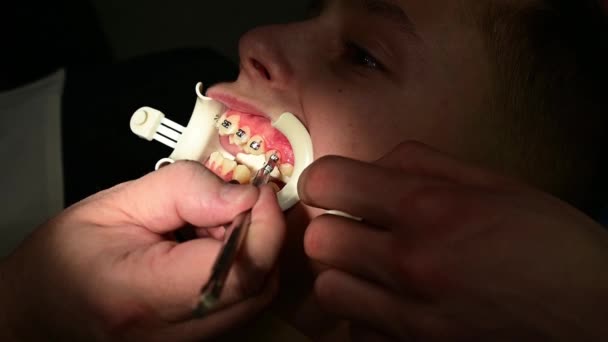 Montering av tandställning på barnets krokiga tänder, ett vitt upprullningsdon på läpparna för att underlätta tandläkarens arbete. — Stockvideo