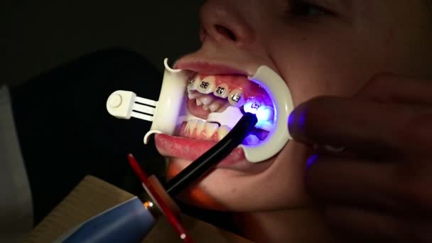 O uso de luz ultravioleta durante a instalação de aparelho, aparelho nos dentes tortos da mandíbula superior. — Vídeo de Stock