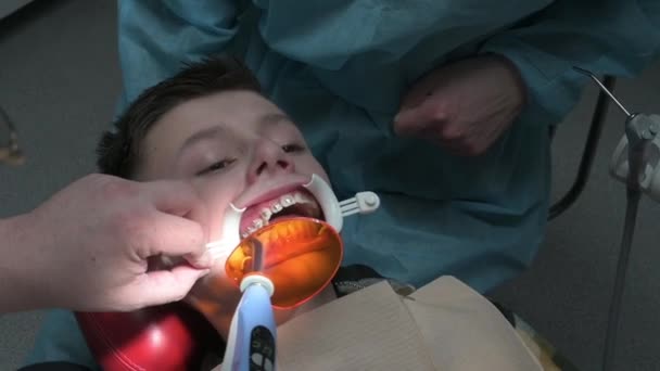在上颌牙上安装支撑、支撑时使用紫外光. — 图库视频影像