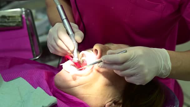 The dentist cleans the tooth from caries with a drill, a dental procedure. — Stock Video