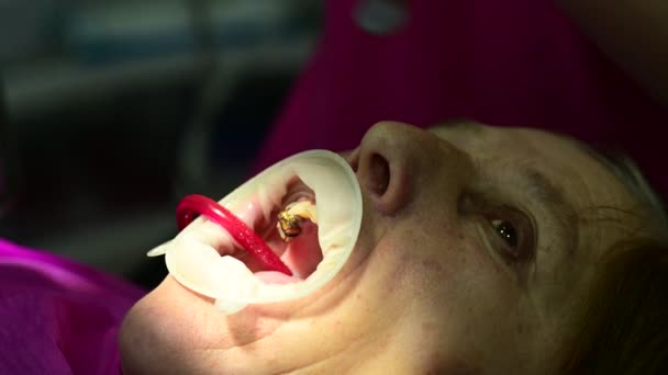 O dentista limpa o dente da cárie com uma broca, um procedimento odontológico. — Vídeo de Stock