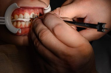 Ortodontist, öğrencinin erkek arkadaşı için diş teli takıyor, dişçiye gidiyor, üst dişlere diş teli takıyor, hastanın dudaklarına retraktör takıyor..