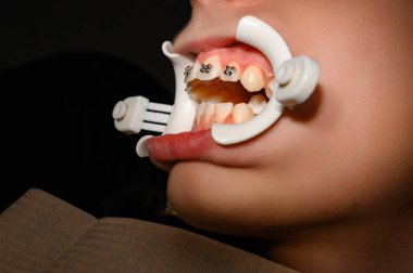 Dudaklarda beyaz retraktör ve ergenin üst dişlerine metal diş telleri yerleştirilmesi, çarpık dişler ve onları diş telleriyle hizalamak..