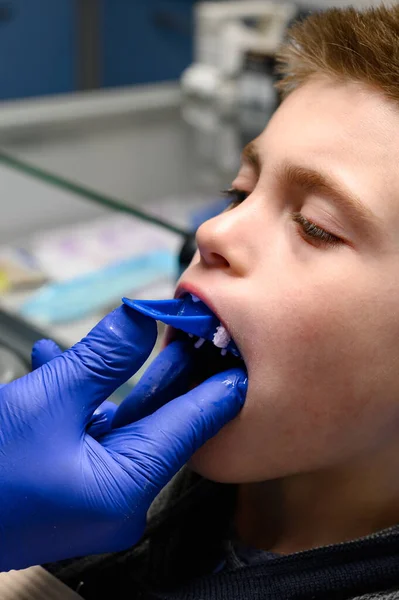 Kieferabdruck Mit Silikon Diagnosemodell Schiefe Zähne Beim Kind Besuch Beim — Stockfoto