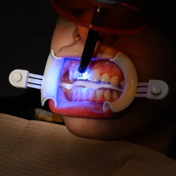 Eğri Dişlerin Diş Tellerinin Yardımıyla Hizalanması Bir Çocuk Için Diş — Stok fotoğraf