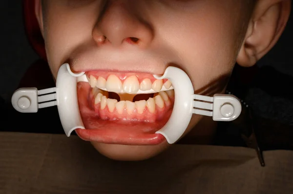Plastic Retractor Lip Augmentation Mouth Dental Procedure Retractor Auxiliary Element — Stock Photo, Image