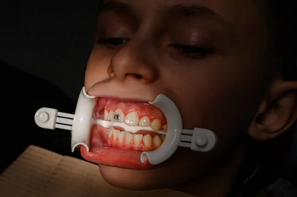 의사가 학생의 친구를 교정기를 설치하고 치과에 윗부분에 교정기를 설치하고 환자의 — 스톡 사진