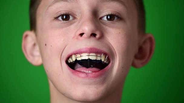 Plat Gigi Untuk Menyelaraskan Gigi Mulut Anak Mengenakan Piring Gigi — Stok Video