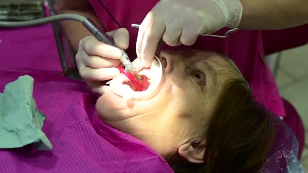 Dentista Pulisce Dente Dalla Carie Con Trapano Una Procedura Dentale — Video Stock