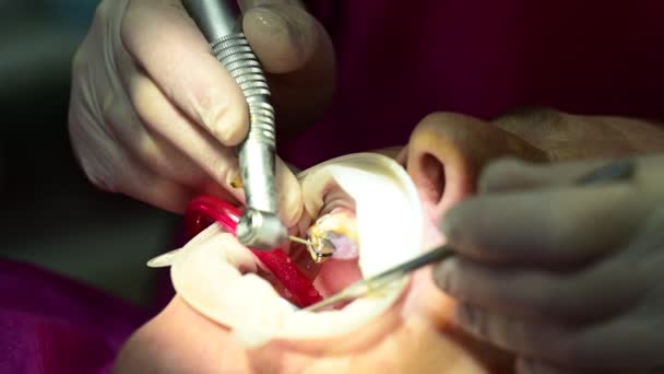 Dentista Limpia Diente Caries Con Taladro Procedimiento Dental Tratamiento Dental — Vídeo de stock