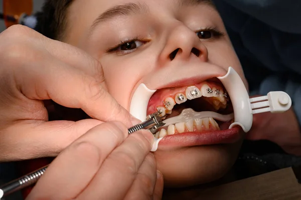 White retractor on the lips and the installation of metal braces on the upper teeth of the teenager, crooked teeth and align them with braces.