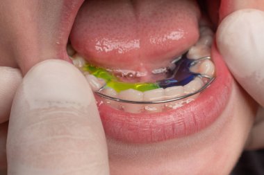 The orthodontist puts a plate on the lower teeth, a visit to the orthodontist, alignment of the child's teeth.