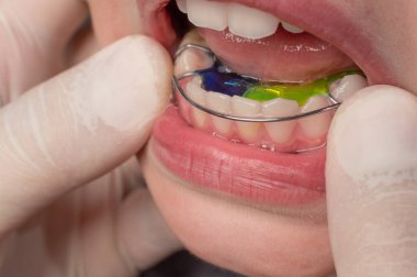The orthodontist puts a plate on the lower teeth, a visit to the orthodontist, alignment of the child's teeth.