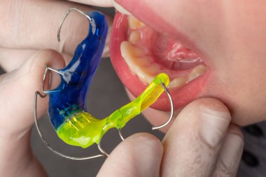 Plate for lower teeth, orthodontist and plate for teeth of the lower jaw, child and plate.