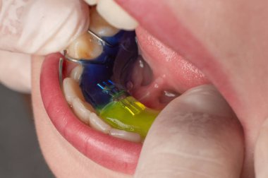 Plate for lower teeth, orthodontist and plate for teeth of the lower jaw, child and plate.