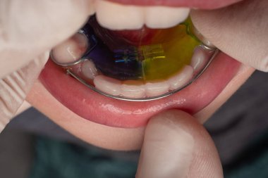 Plate for lower teeth, orthodontist and plate for teeth of the lower jaw, child and plate.