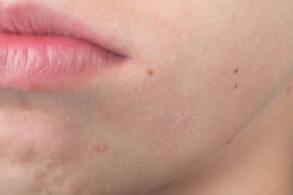 Teenager Has White Pimple His Beard Pimple Child Face Detail — Photo