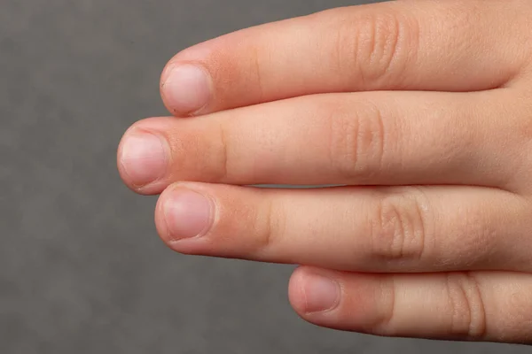 Dirty Sloppily Trimmed Child Fingernails Fingers Toenails Close Little Child — стоковое фото