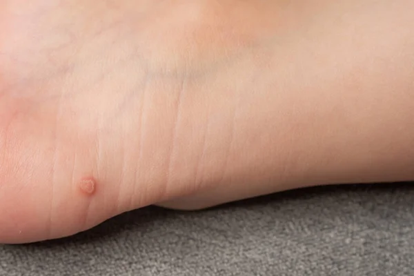 Common Wart Verruca Vulgaris Skin Child Papillomavirus Body — Fotografia de Stock