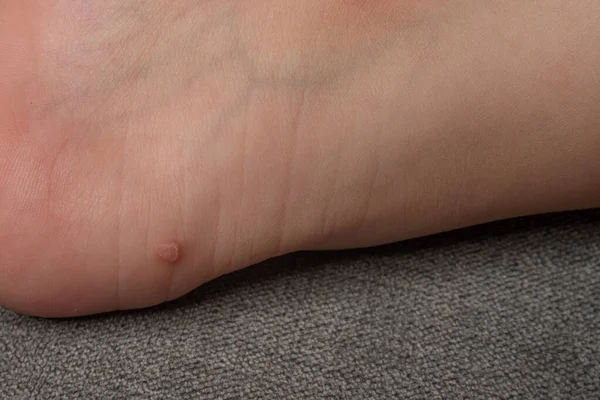 Common Wart Verruca Vulgaris Skin Child Papillomavirus Body — Fotografia de Stock
