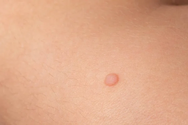 Common Wart Verruca Vulgaris Skin Child Papillomavirus Body — стоковое фото