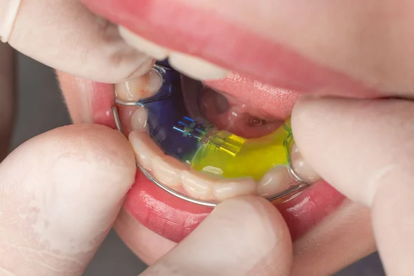 Orthodontist Puts Plate Lower Teeth Visit Orthodontist Alignment Child Teeth — Zdjęcie stockowe